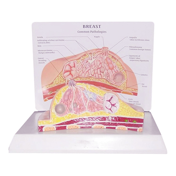 Female Breast Model Pathological Breast Cross-Section Anatomical Model