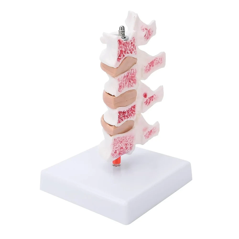 Osteoporosis Model 3Vertebral